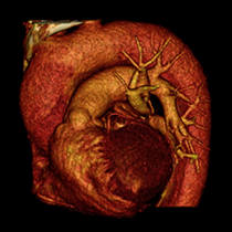Dissezione aortica (tipo A)